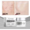 West&Month Acne Cream, Refreshing Oil Control Acne Mild Closing Face Cream